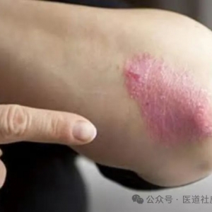 澳大利亚国立大学科学家发现驱动牛皮癣和牛皮癣关节炎的基因突变